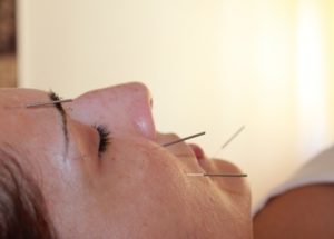 Lifting con acupuntura kyreo